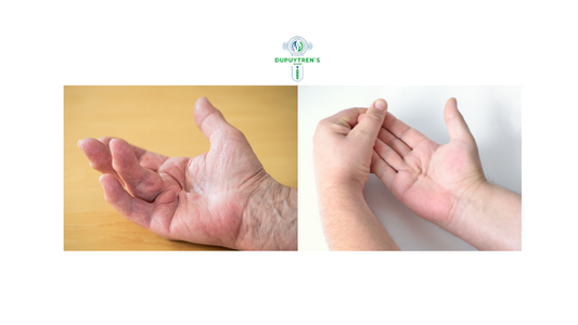 Causes of Dupuytren’s Contracture