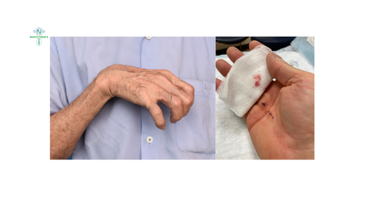 What Happens to Your Hand When You Have Dupuytren’s Contracture Surgery?