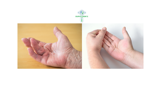 Causes of Dupuytren’s Contracture 