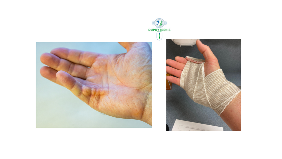 Do Splints Work As A Dupuytren’s Contracture Treatment?