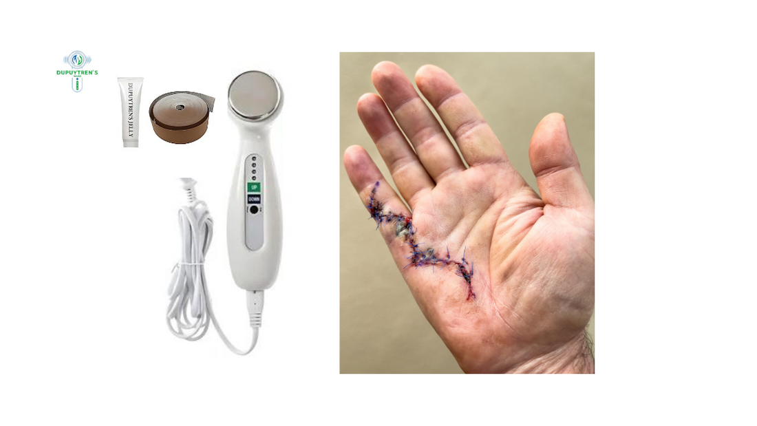 How To Treat Dupuytren’s Contracture without Any Surgery?