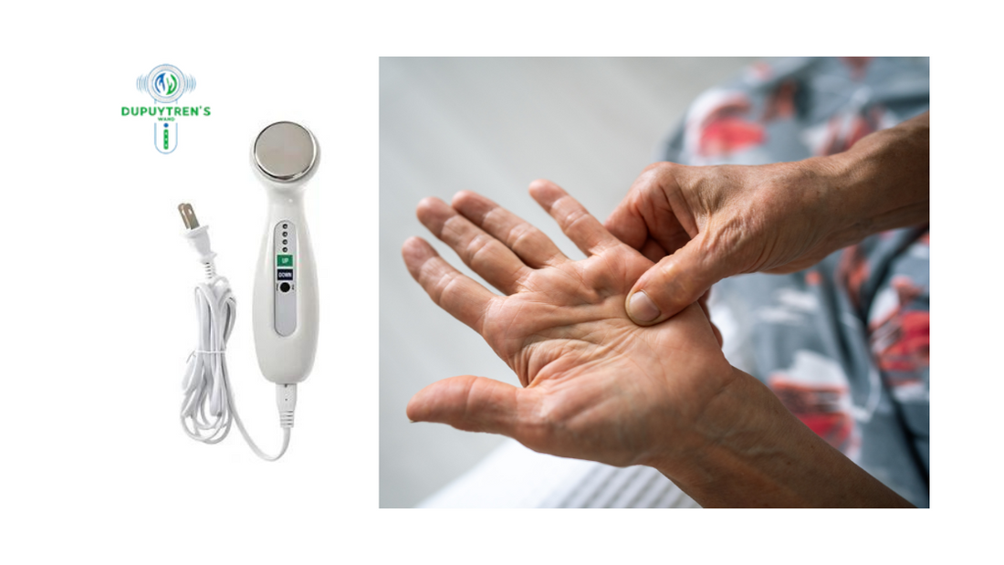 How to Cure Dupuytren's Contracture Naturally