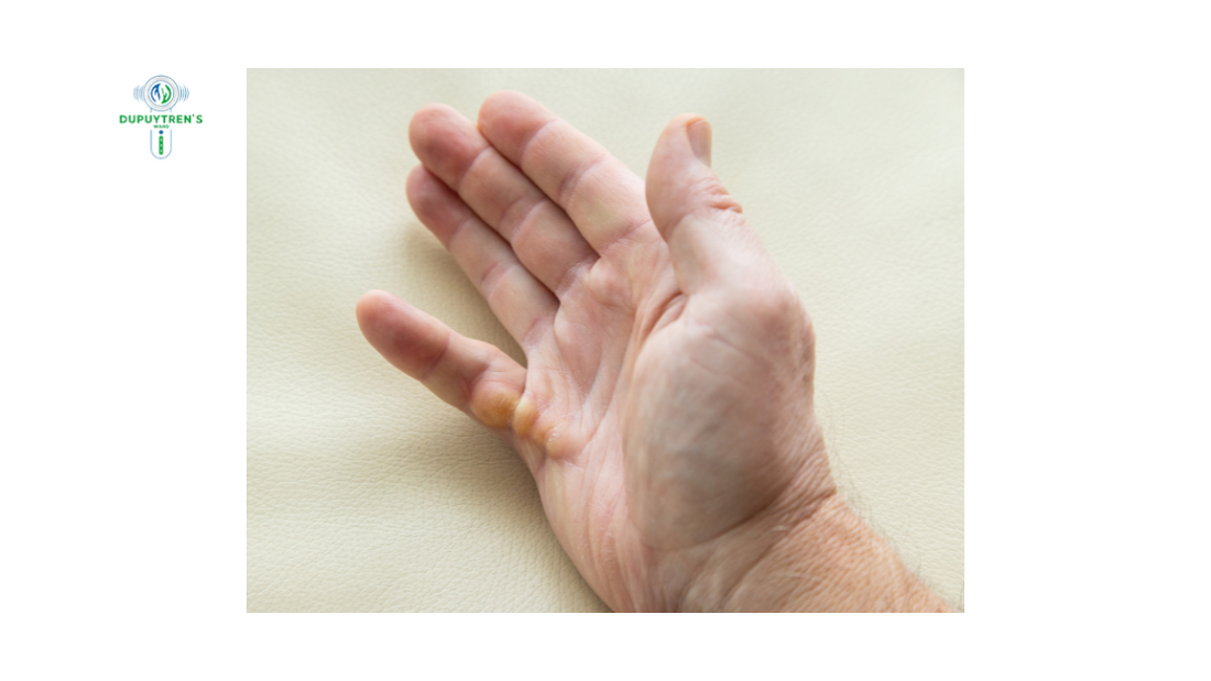 Is Dupuytren’s Contracture A Sign Of Cancer?