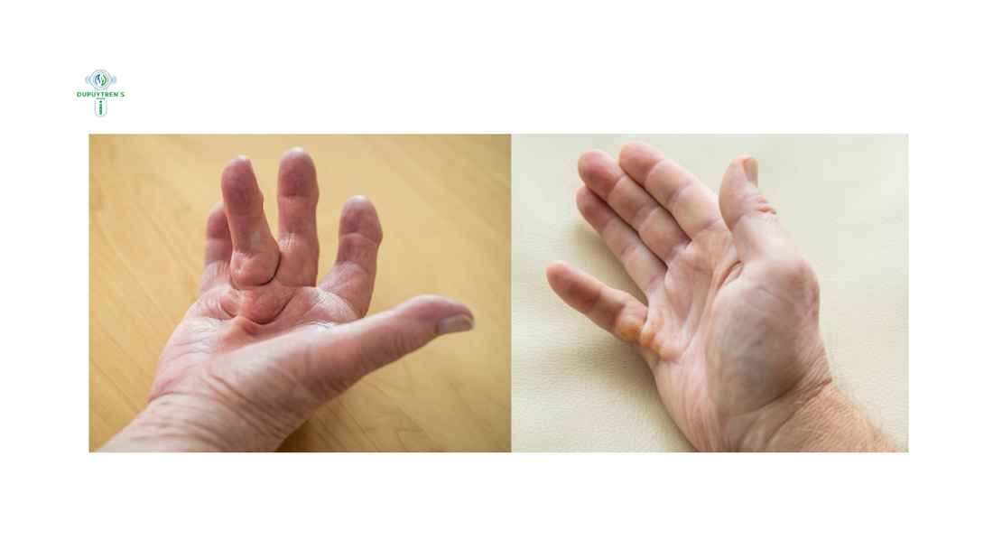 What Causes Dupuytren’s Contracture? Can Dupuytren’s Be Inherited?