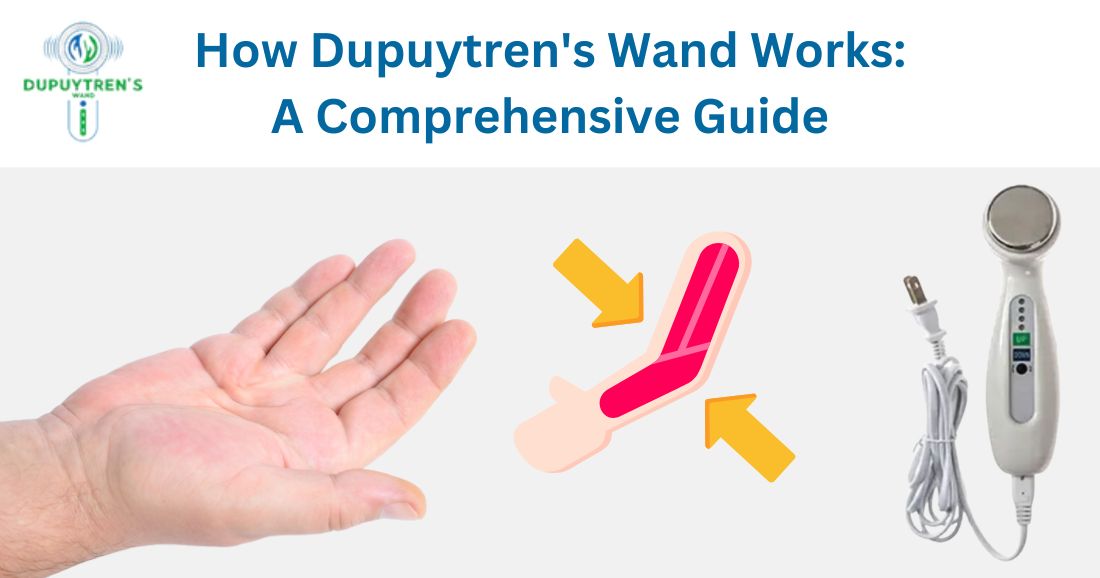 How Dupuytren's Wand Works: A Comprehensive Guide